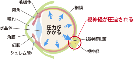 緑内障で働きながらでも障害年金2級認定!視野欠損の認定基準と諦めない申請方法